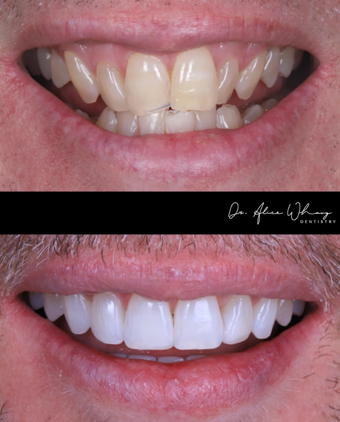 Close-up of a patient's smile before treatment (top) and after treatment (bottom), treated by Dr Alice Whang