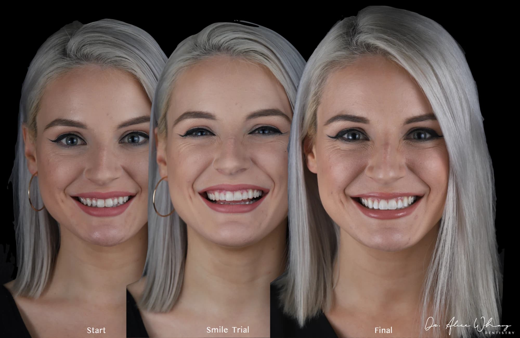 A patient's smile at the start, at the smile trial and after final treatment, left to right, treated by Dr Alice Whang