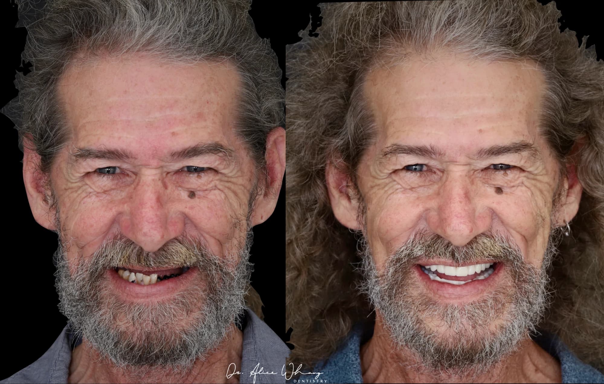 A patient's smile before treatment (left) and after treatment (right), treated by Dr Alice Whang