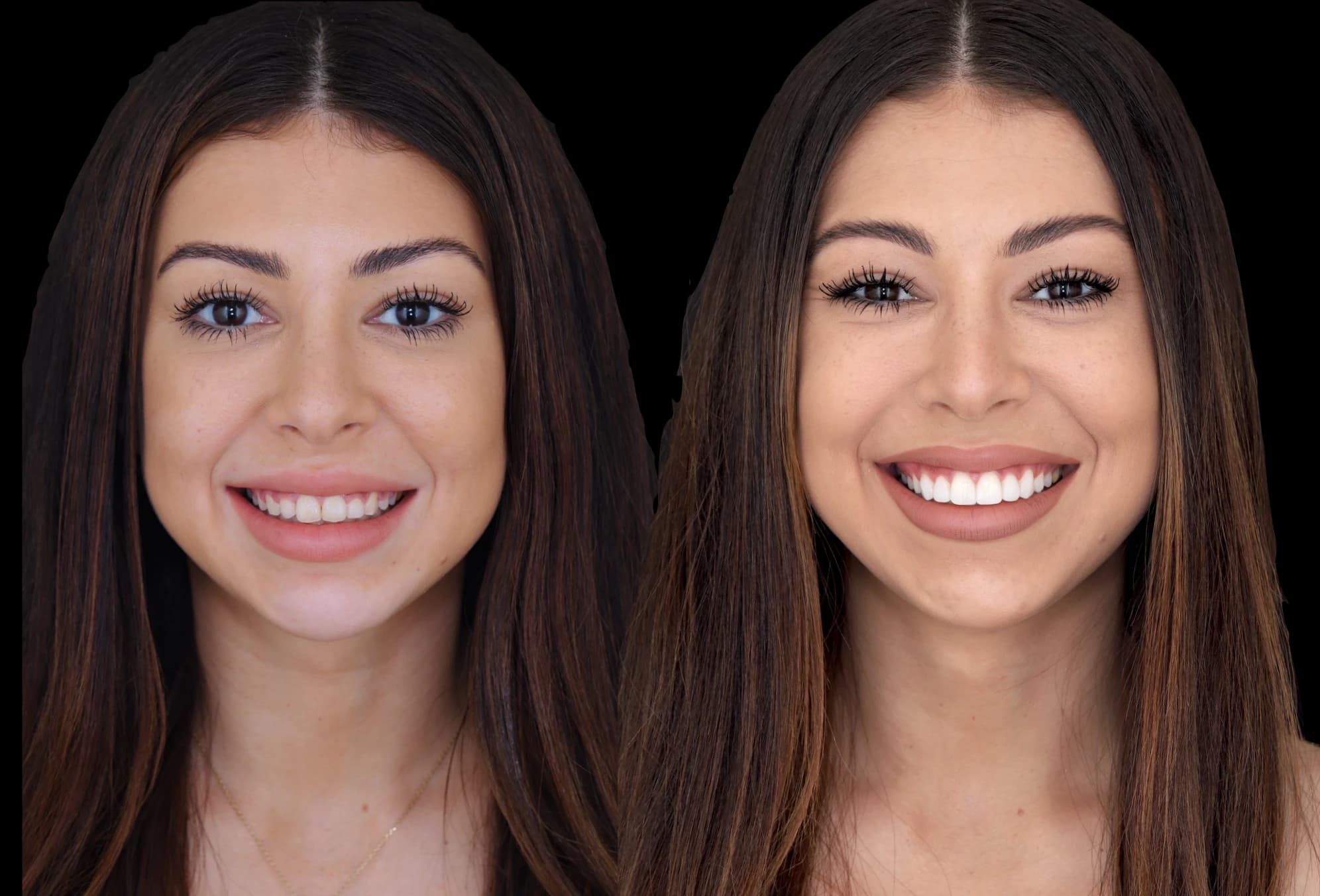 A patient's smile before treatment (left) and after treatment (right), treated by Dr Alice Whang