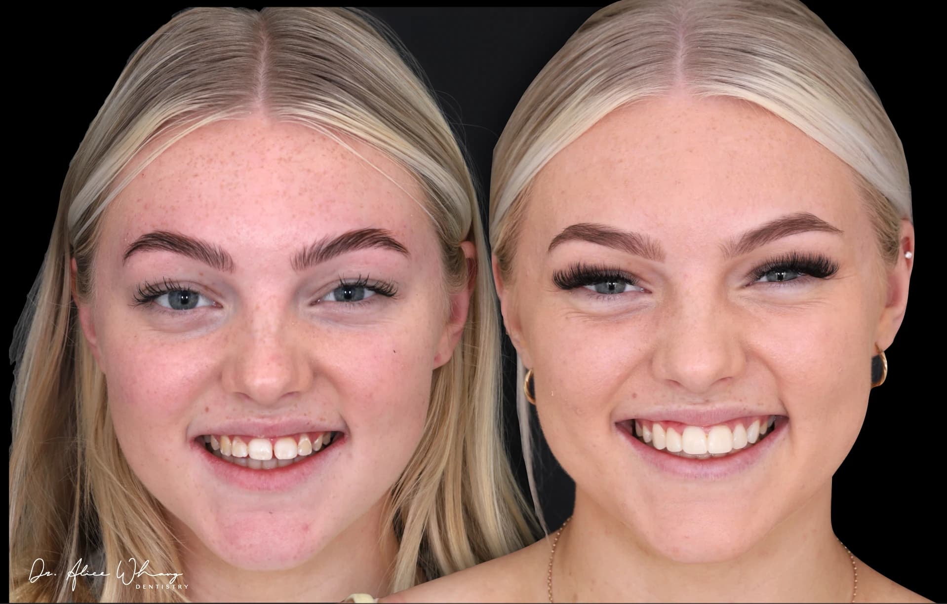 A patient's smile before treatment (left) and after treatment (right), treated by Dr Alice Whang