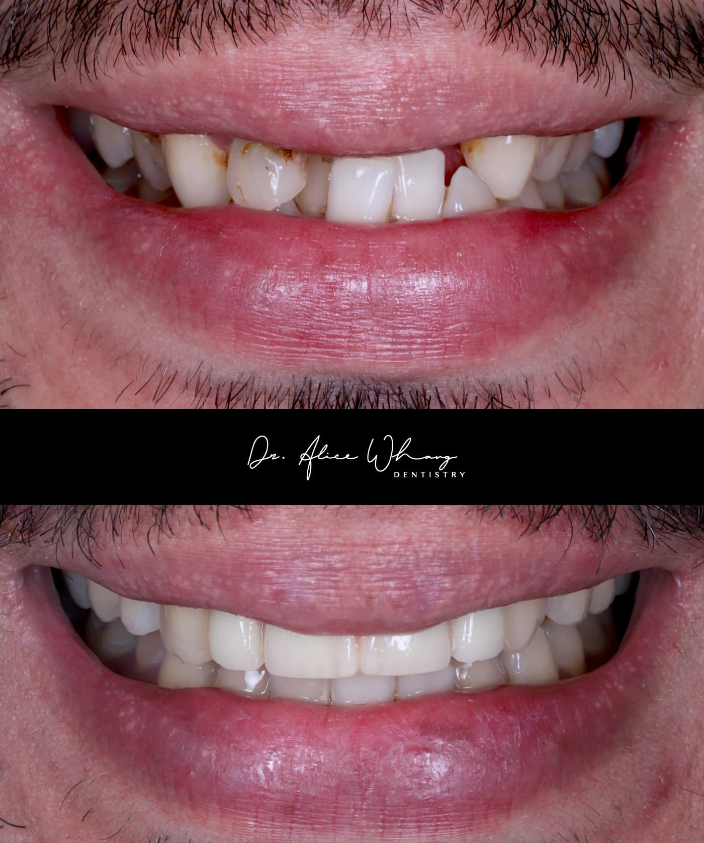 Close-up of a patient's smile before treatment (top) and after treatment (bottom), treated by Dr Alice Whang