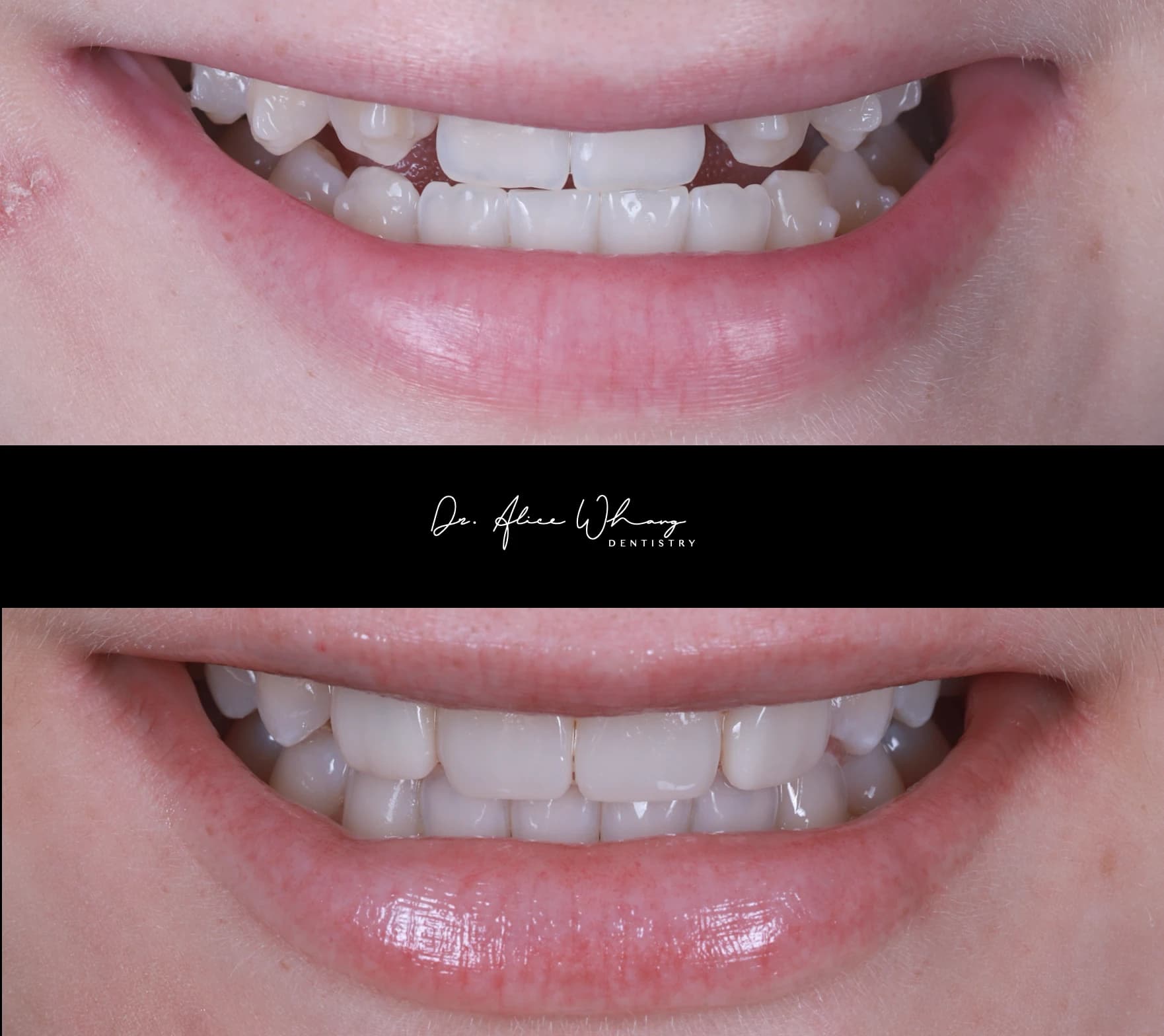 Close-up of a patient's smile before treatment (top) and after treatment (bottom), treated by Dr Alice Whang