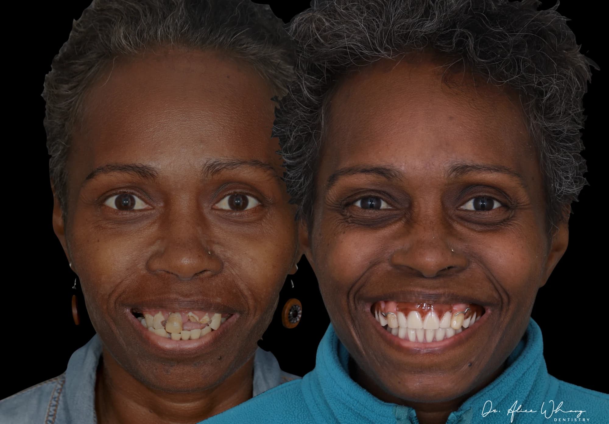 A patient's smile before treatment (left) and after treatment (right), treated by Dr Alice Whang