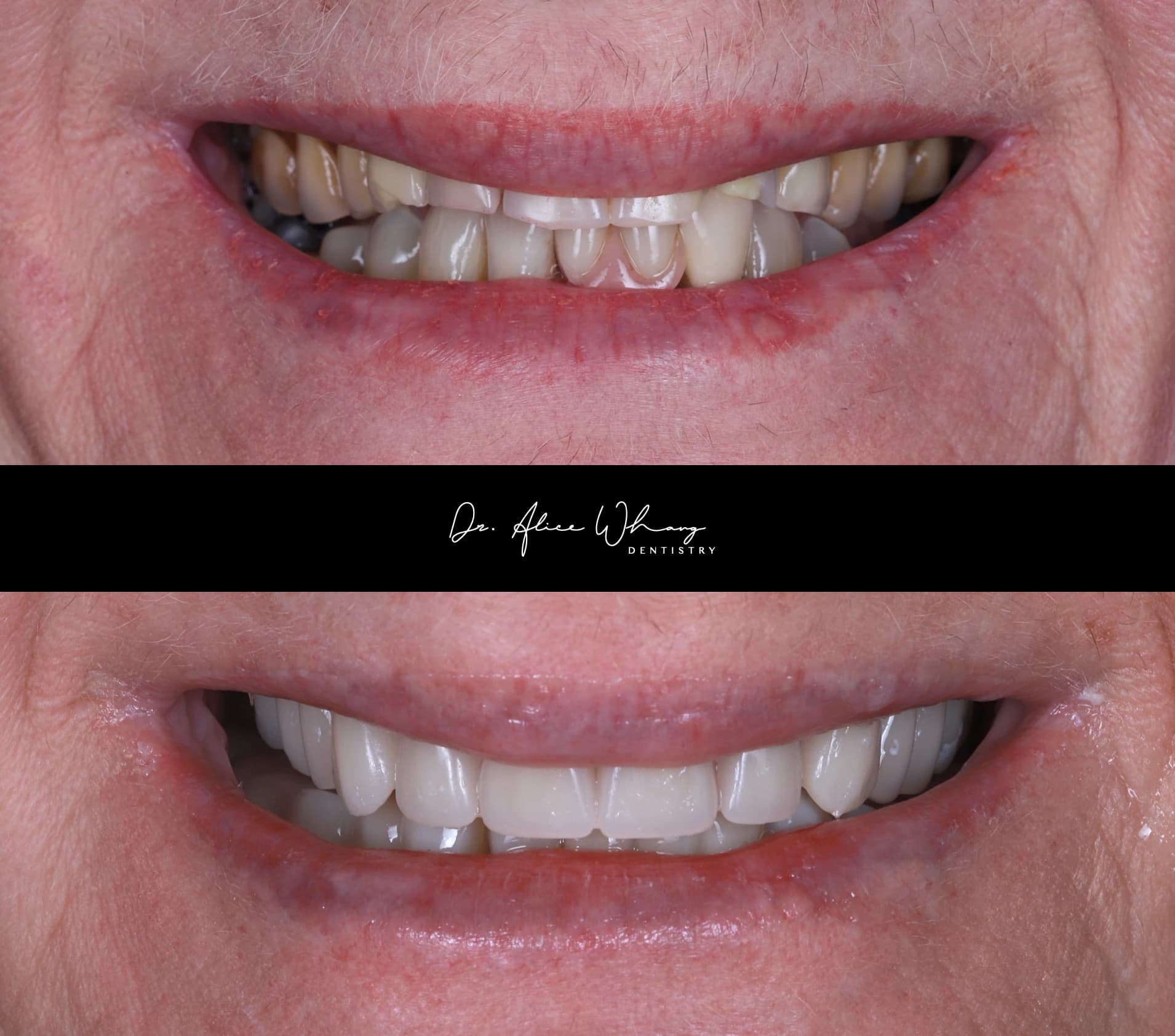 Close-up of a patient's smile before treatment (top) and after treatment (bottom), treated by Dr Alice Whang